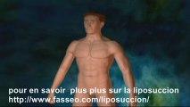 Liposuccion du ventre (où lipoaspiration), comprendre la liposuccion