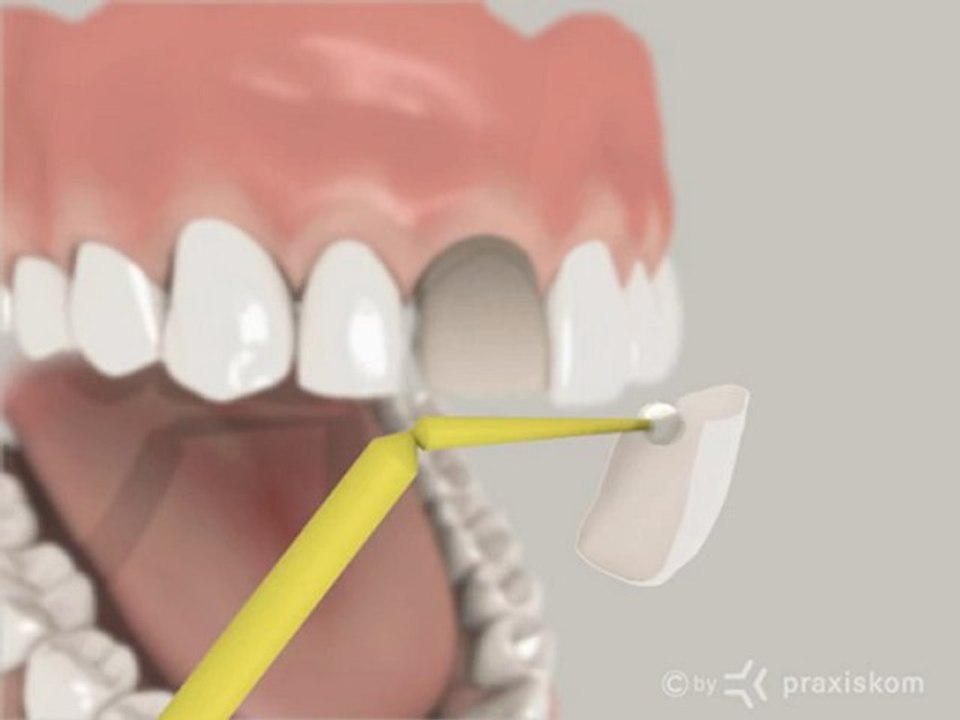 Les facettes dentaires