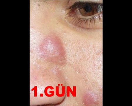 SİVİLCE KREMİ LAMOS MUCİZEVİ ETKİSİNİ BU VİDEO İLE KANITLIYORUZ.