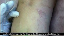 Amazing Vein Removal with Asclera Injections