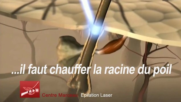 Epilation Laser Definitive A Paris | Centre Marceau