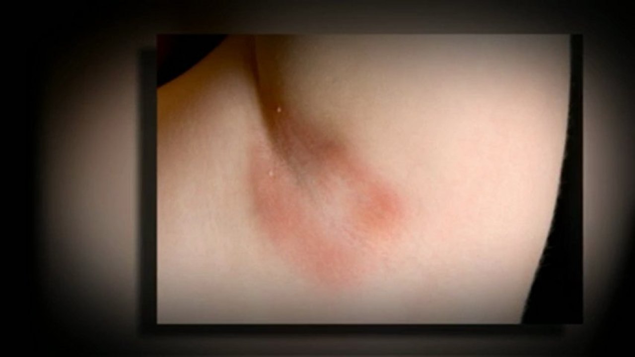 YEAST INFECTION