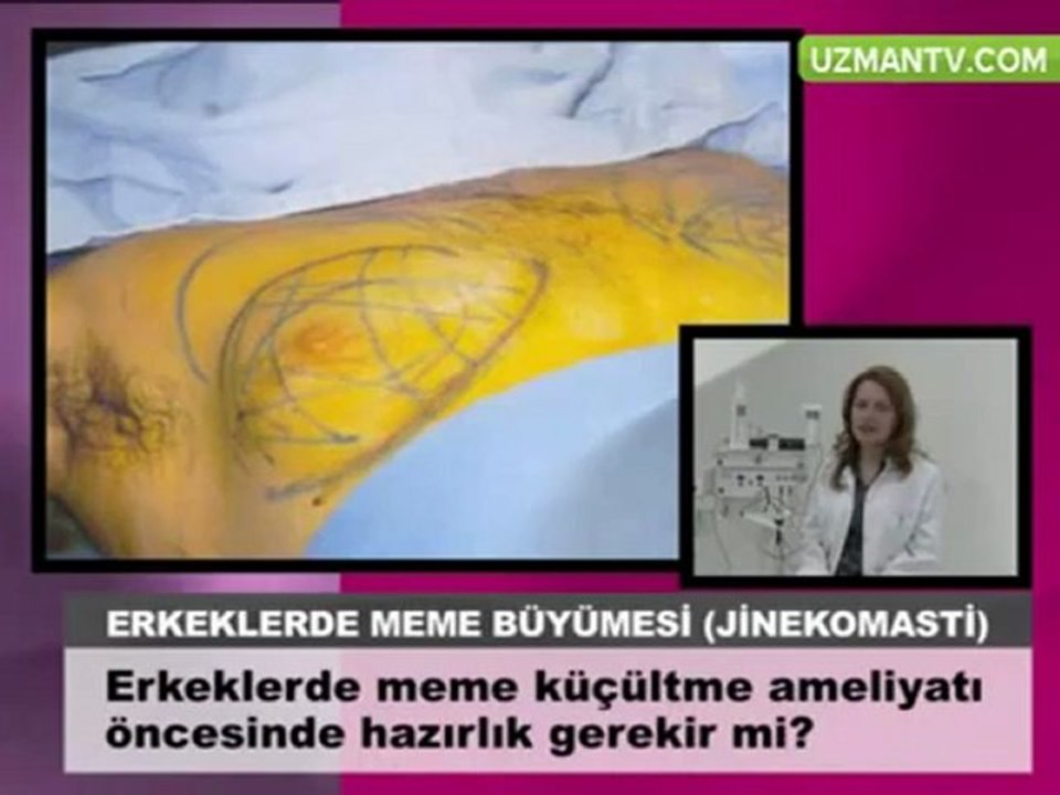 Op Dr Eser Aydogdu Erkeklerde meme kucultme ameliyatı