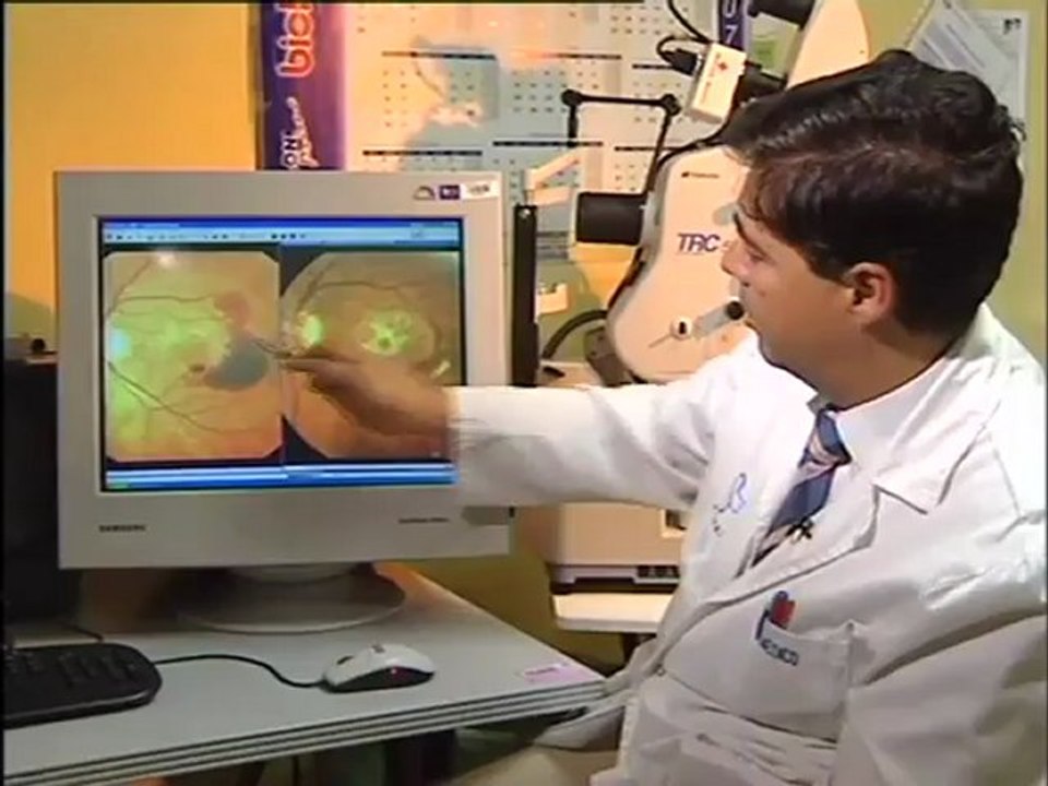 degeneración macular asociada a la edad