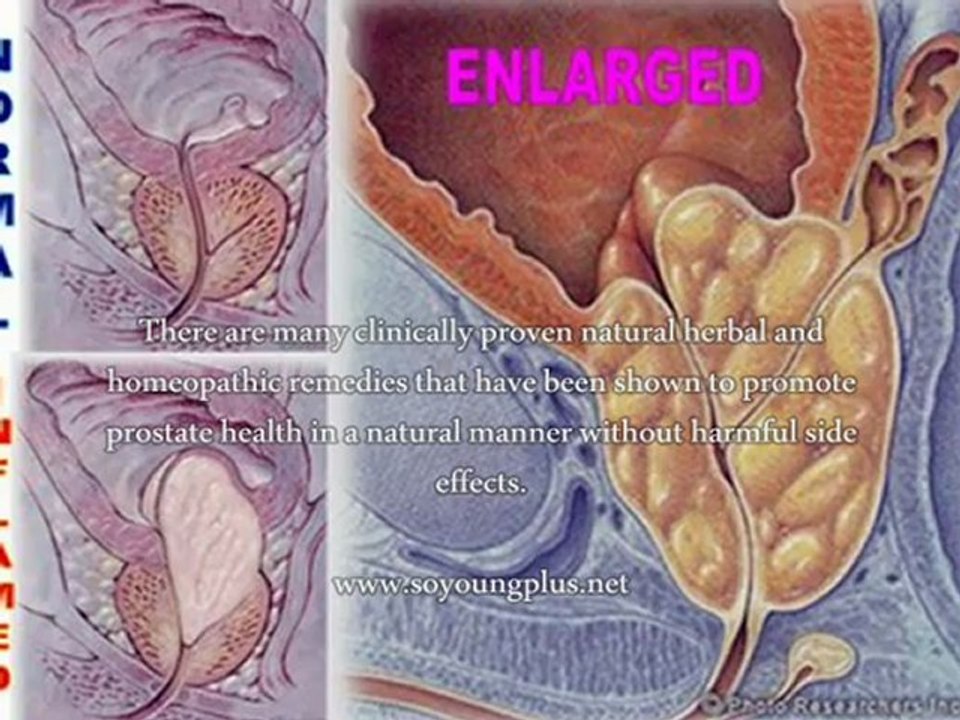 How To Reduce Prostate Enlargement Naturally?