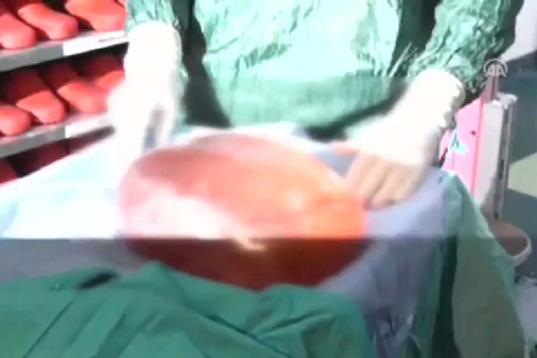 Karnından 10 kg kitle çıktı