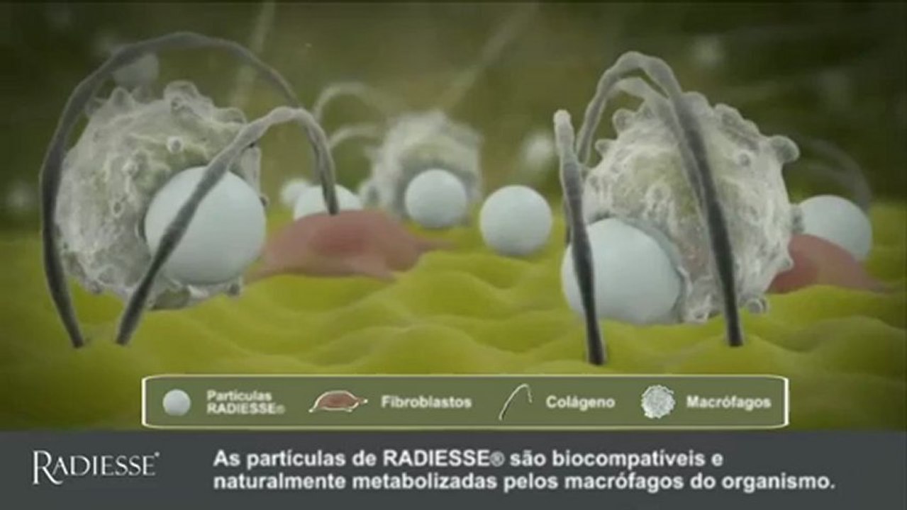 Radiesse