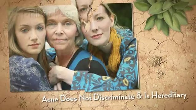 acne-facial-treatment-chesterton-indiana-219-229-0822