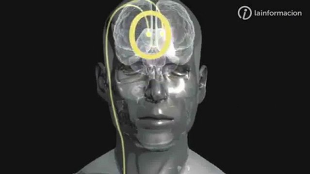 Neuroprotesis para el Parkinson: Estimulacion cerebral profunda