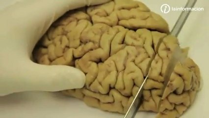 Alzheimer: Anatomia del olvido