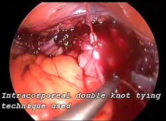 murat api enseal laparoscopic hysterectomy