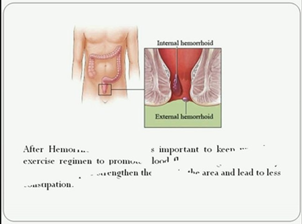 What type of exercises you need to do after hemorrhoid surgery?