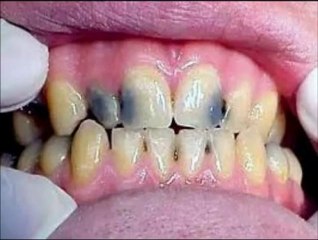 A 25 ans, il a perdu toutes ses dents après avoir bu trop de soda