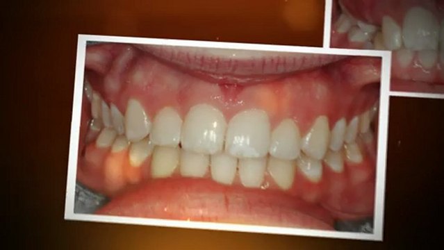 Littleton Invisalign Nov2012