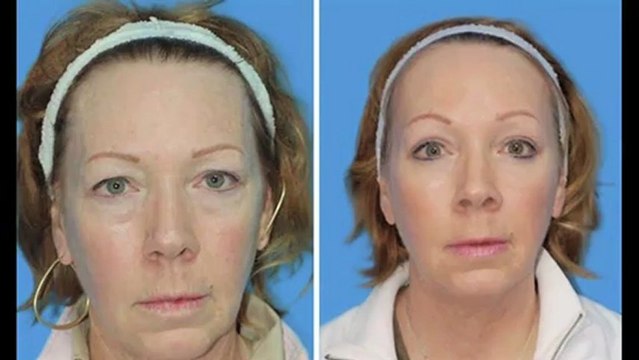 Why Boulder Plastic Surgery? in Boulder, CO