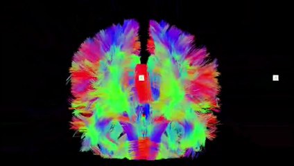 Esquizofrenia: Voces en el cerebro (Red por defecto)