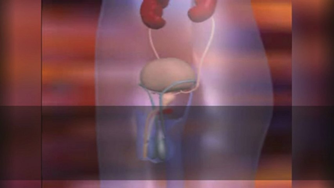 Prostate Laser Vaporization for Prostate Enlargement