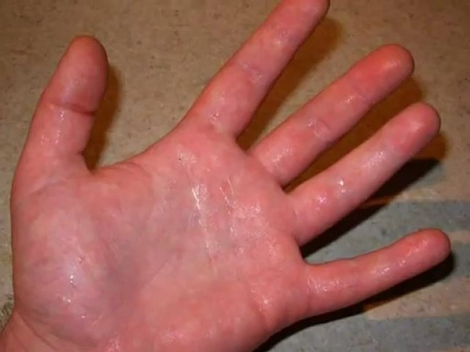 How to Treat Sweaty Hands?