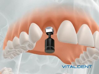 Implante Vitaldent unitario