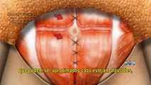 Cirurgia Plástica de Abdome - Dr. Bruno C. André