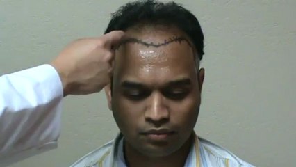 Choosing the specialists for Thinning Hair