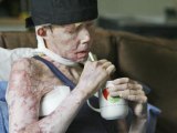 Lye victim gets new face in transplant surgery
