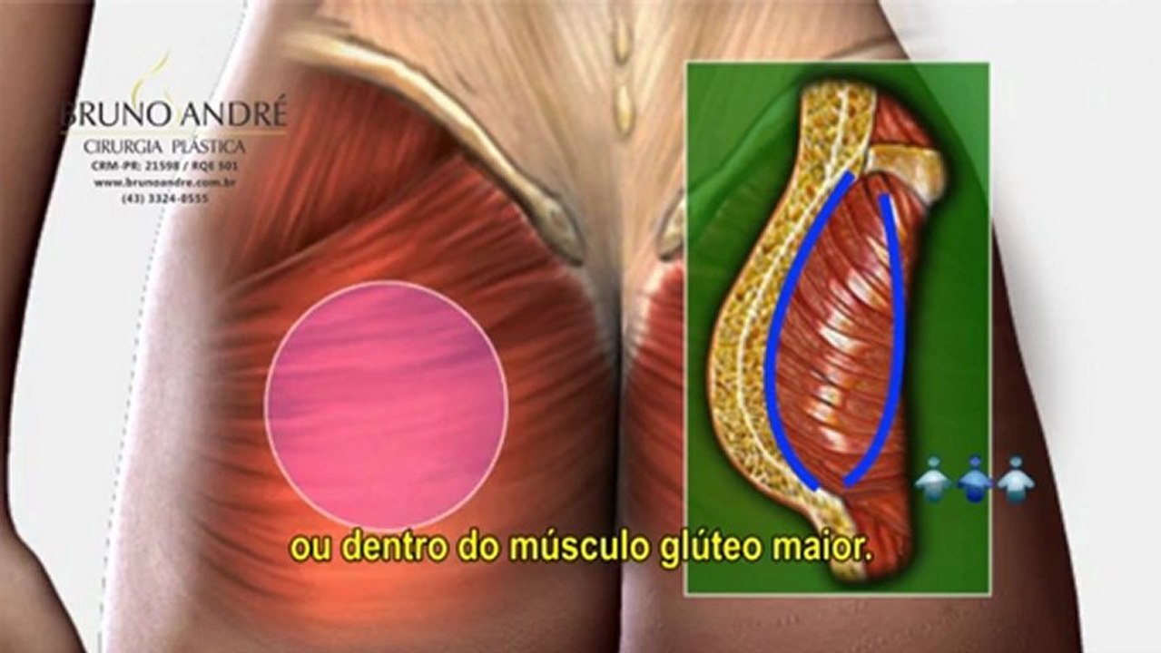 Cirurgia de Prótese de Glúteo - Dr. Bruno C. André