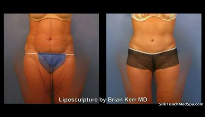 Silk Touch Medspa Liposuction Knees and Thighs