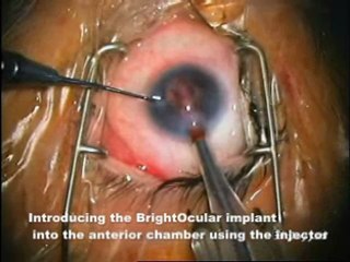 Artificial iris brightocular restores mans light brown eyes