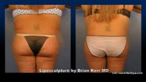 Silk Touch Medspa Liposuction Love Handles