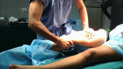 ACL surgery in Chennai -Anatomic  method, hamstring graft, transportal technique