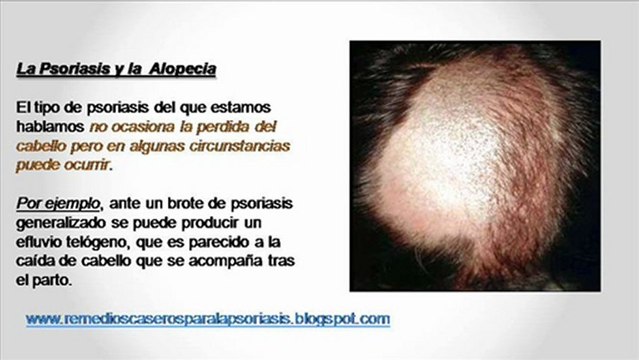Psoriasis en el cuero cabelludo
