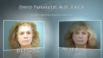 Rhinoplasty Fairfield County, Connecticut