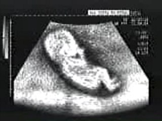 Ecographie de Juan Pablo Montoya