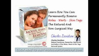 Natural Home Remedies: Home Remedies Removing Moles