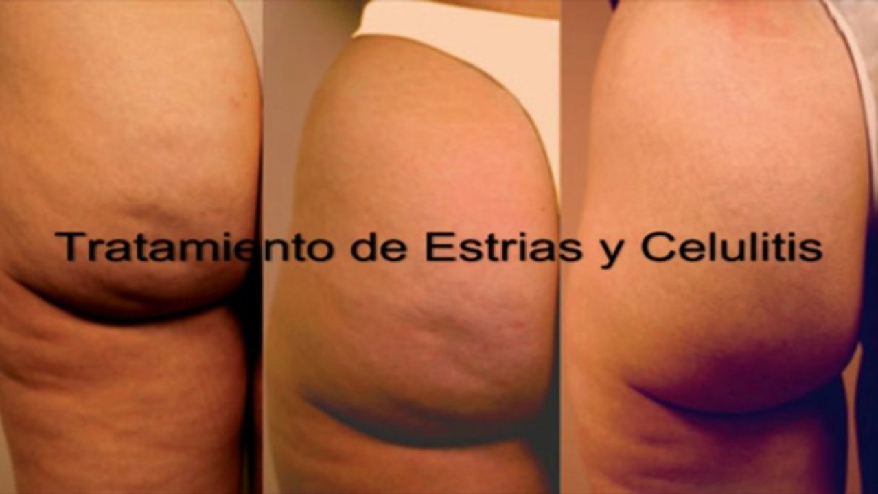 Estrias y Tratamiento de la Celulitis