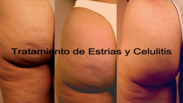 Estrias y Tratamiento de la Celulitis