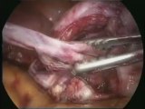 Laparoskopik yöntem (kapalı ameliyat) ile çikolata (çukulata) kisti, endometrioma,endometriozis operasyonu