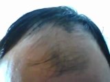 Alopecia Androgenetica - Calvizia maschile - Alopecia Maschile - Calvo Uomo