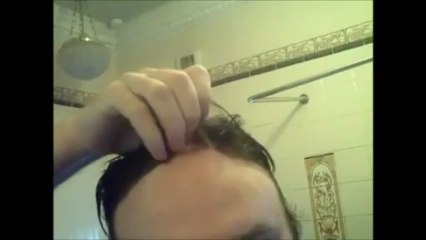 Non Surgical Men's Hair Replacement System (our client's video demonstration)