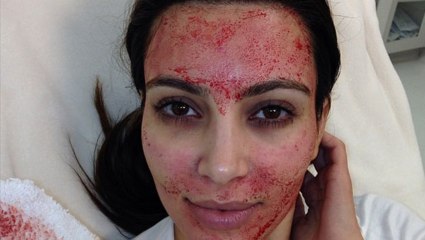 Kim Kardashian a le visage en sang