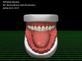 Dentures and Dental Implants at O'Fallon Dental Care