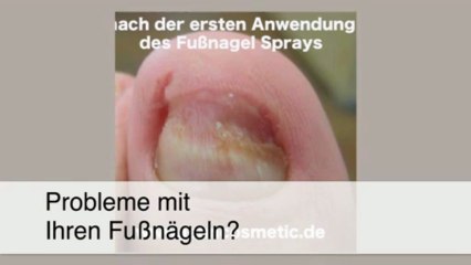 Nagelpilz - Grünwald medizinisch-wissenschaftliche Jenn Cosmetic