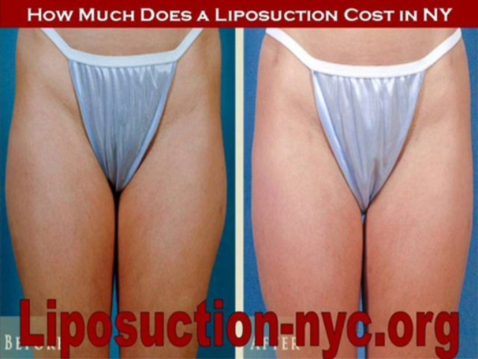 Basic Facts about NYC Liposuction
