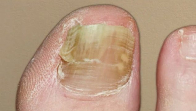 Podiatrist - Laser Therapy Fungal Toenails -Cleveland, Cuyahoga, Lake and Geauga, OH