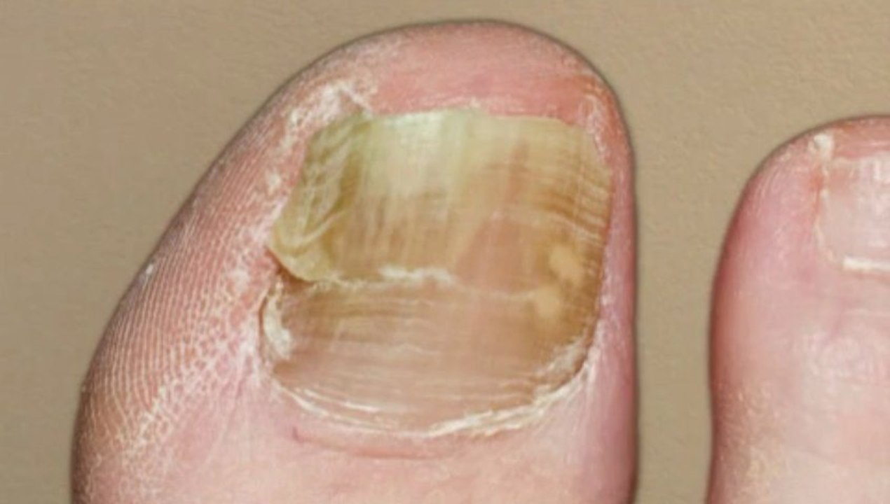 Podiatrist - Laser Therapy Fungal Toenails -Cleveland, Cuyahoga, Lake and Geauga, OH