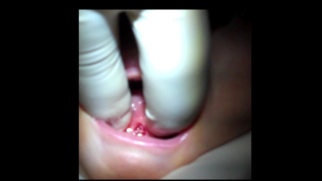 Frenotomie simple, complète pour un BB de 6 mois