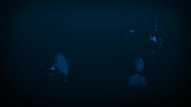 Dermal Fillers In Milton Keynes