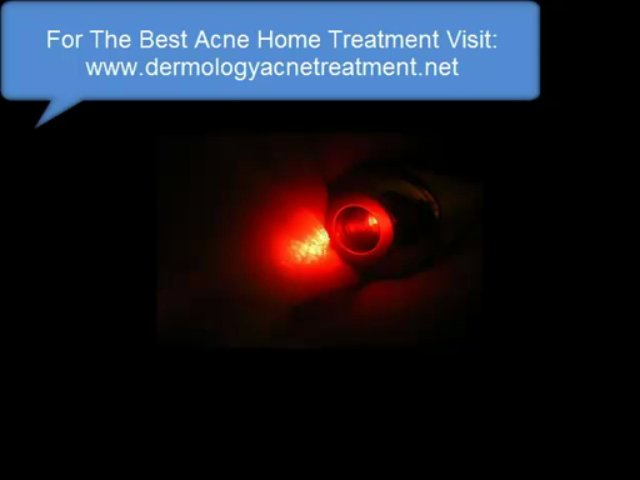 acne home treatment – home treatment