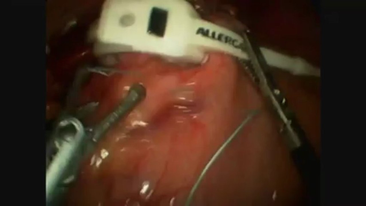 Lap Band Surgery How it's Performed by Bay Bariatric Surgery